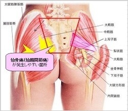 腰痛ではない 仙骨痛 仙腸関節痛