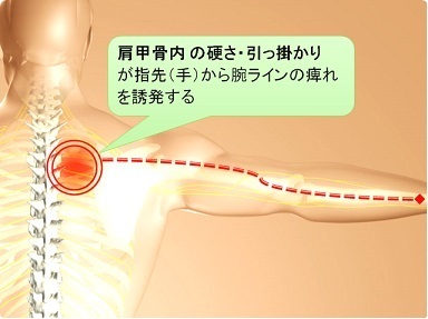 背中の痛みを伴う手の痺れを改善