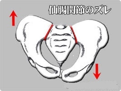 仙腸関節のずれ