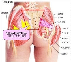 仙腸関節の痛み (Sacroiliac joint Pain)