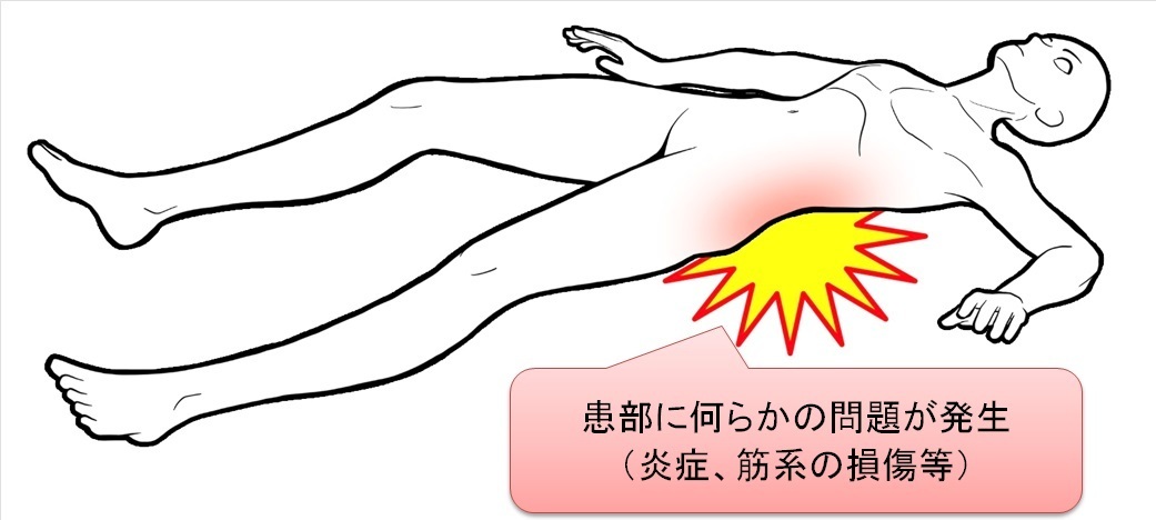 痛みや炎症に対する整体1