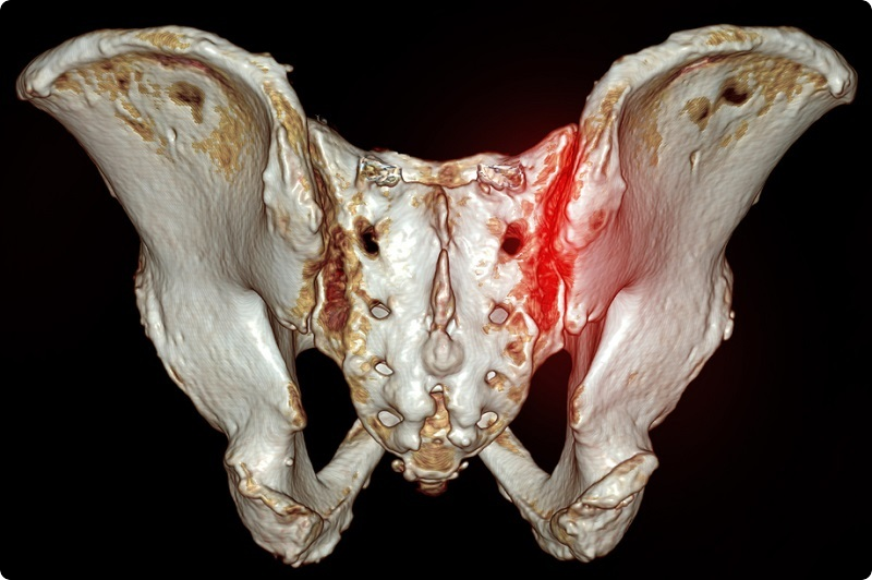 仙腸関節の痛み
