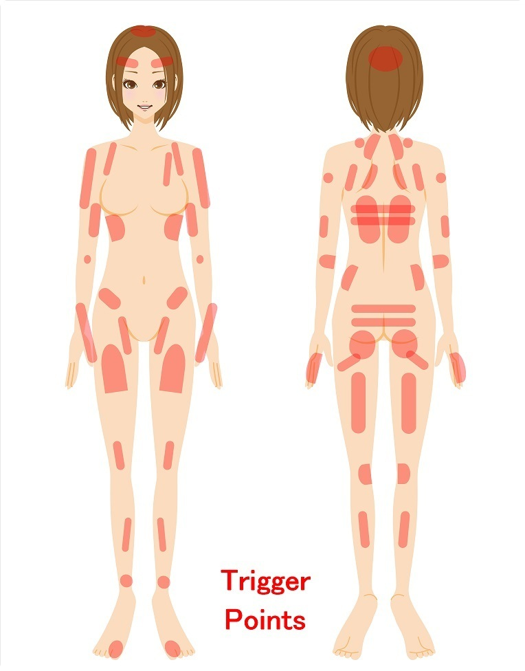 Trigger Points_image