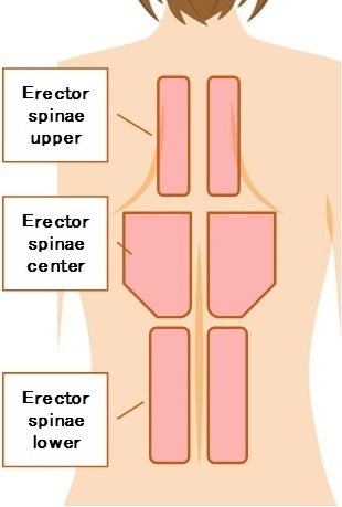 Erector_spinae_tention
