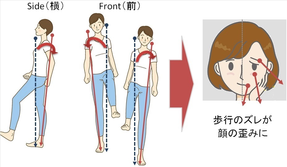 歩行の崩れと顔の歪み