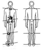 Body distortion and sacroiliac joint pain